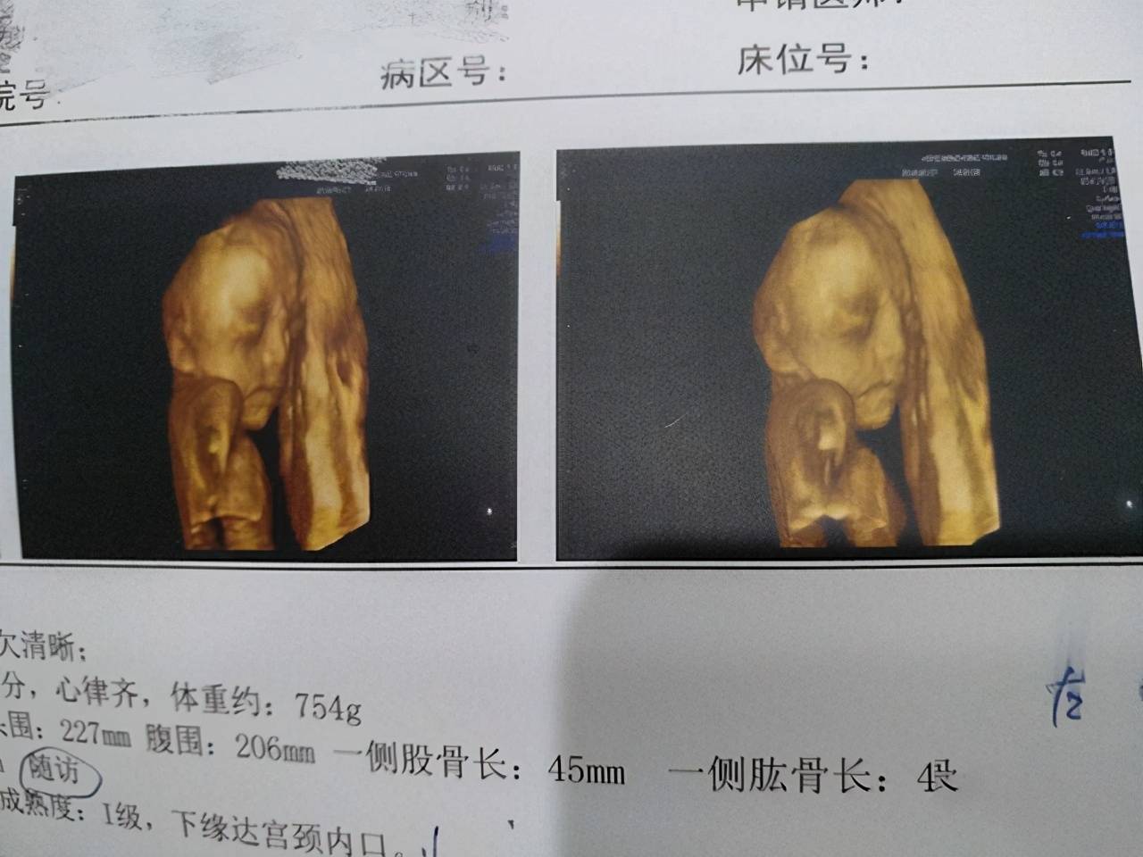 全球各地宝宝四维彩超照片集锦：探秘宝宝成长瞬间