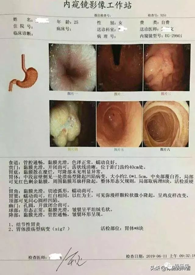 活检确诊攻略：医生教你如何看懂胃镜病理报告与胃癌诊断结果