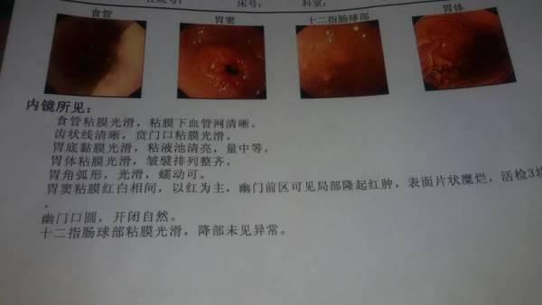 活检确诊攻略：医生教你如何看懂胃镜病理报告与胃癌诊断结果