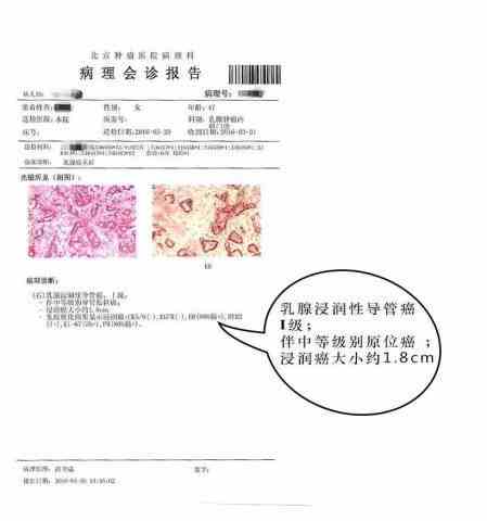 教你如何解读乳腺癌病理报告：医生教你怎样看懂乳腺癌细胞信息