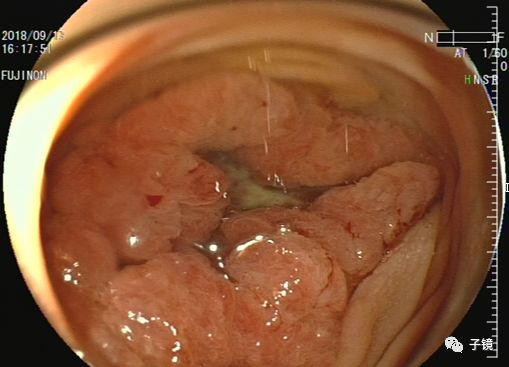 病理报告AI16：如何判断良性恶性，详解管状腺瘤、子宫内膜增生与肠息肉报告