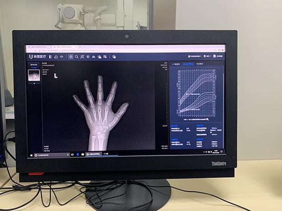 如何解读AI骨龄预测报告单：掌握报告怎么看的关键步骤