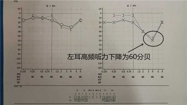 电测听力测试中声音缺失，按了确认键，医生：对结果影响解析