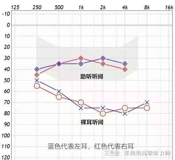 纯音听阈报告上的AI是什么：均值中的AI含义及测定报告解析