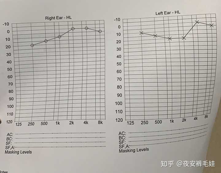 纯音听阈报告上的AI是什么：均值中的AI含义及测定报告解析