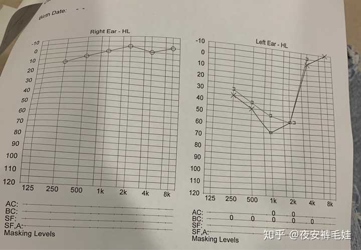 纯音听阈报告上的AI是什么：均值中的AI含义及测定报告解析