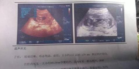 全面解读三维彩超报告：关键数据与常见问题详析