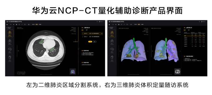 肺CT报告AI提示