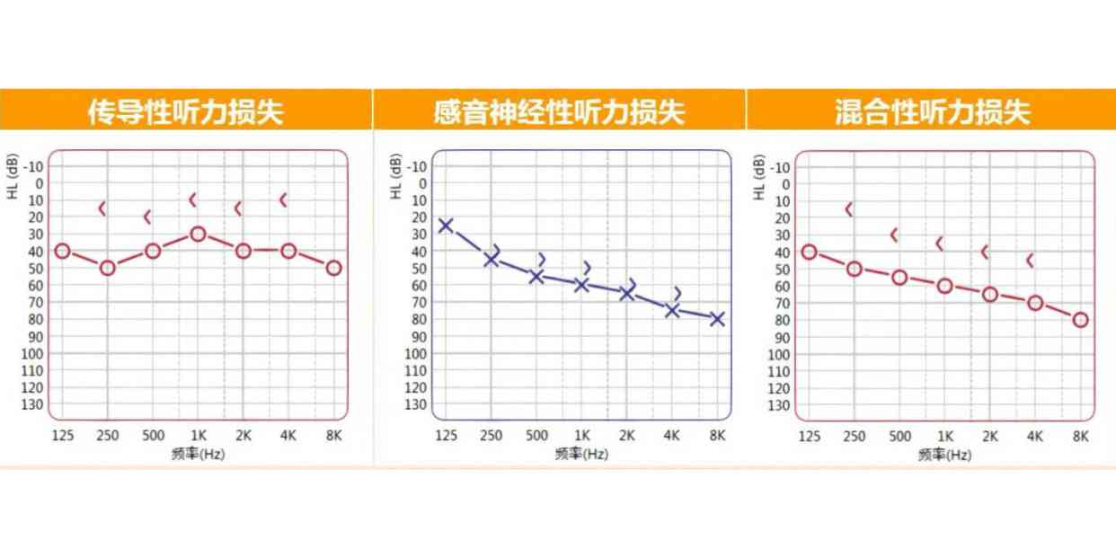 全面听力评估报告：AI智能分析值解读与综合诊断结果