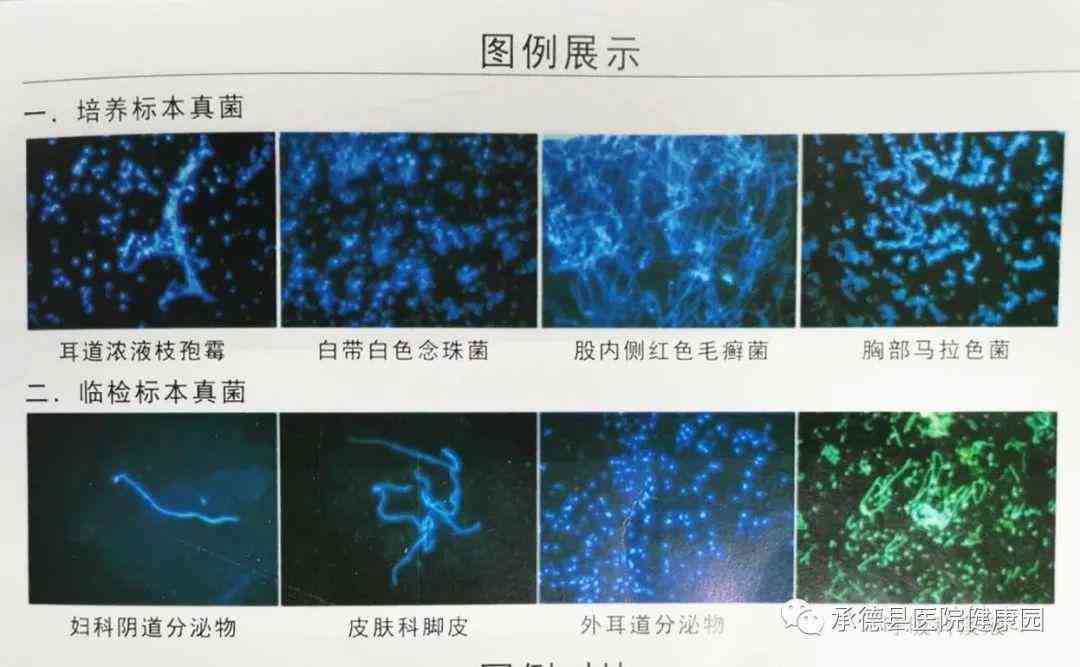 真菌荧光镜检操作流程：实与阳性结果含义解析