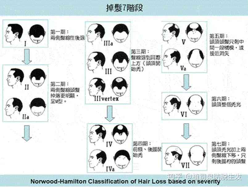 全方位解析脱发原因与解决方案：告别脱发困扰，找回秀发自信