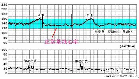 智能胎心监护：AI报告解读与生命安全保障