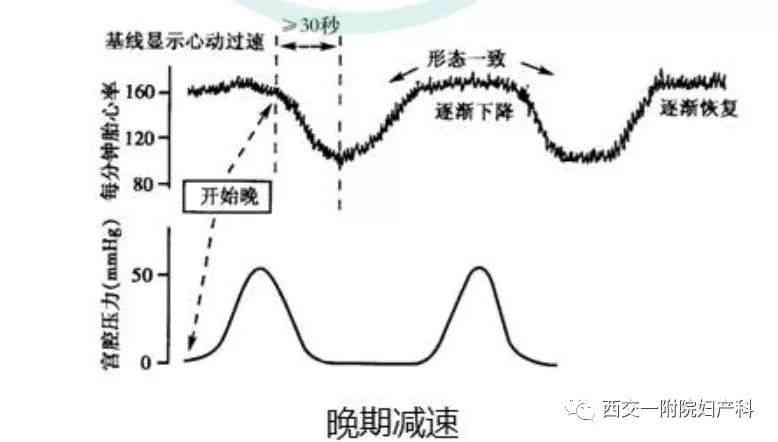 胎心监护ioco是什么：胎心监护e.uc、acceleration、ld、ltv的含义解析