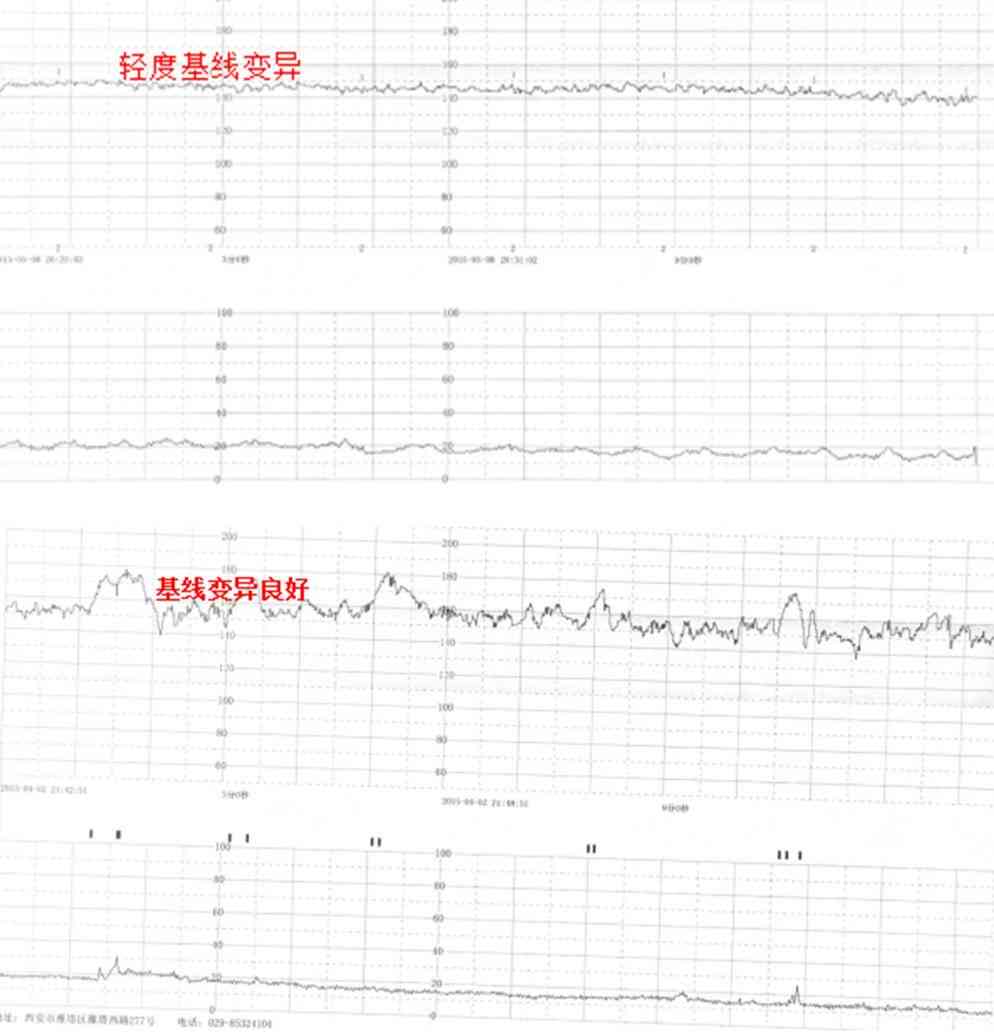 胎心监护ioco是什么：胎心监护e.uc、acceleration、ld、ltv的含义解析