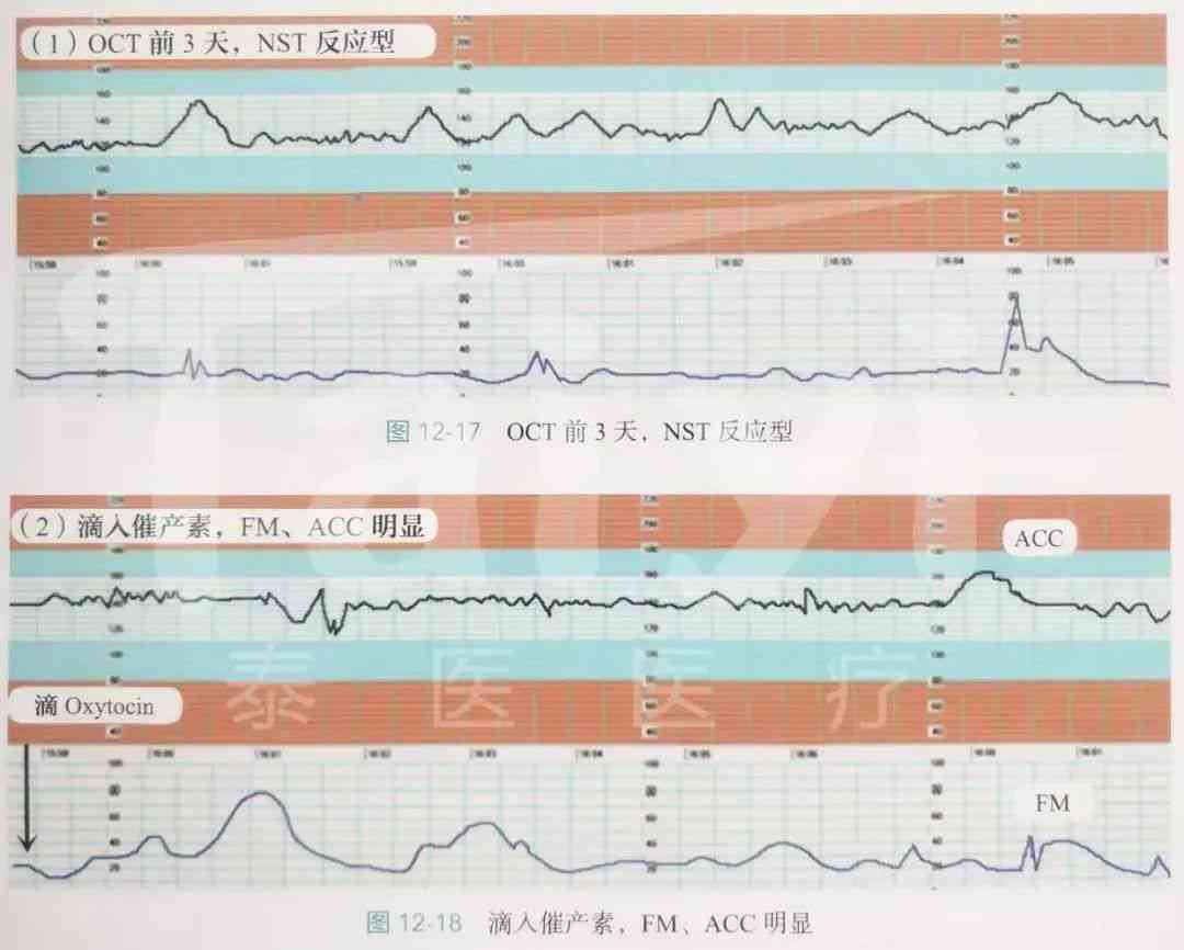 全面解读胎心监护报告：评价指标、图形分析、异常情况与应对策略