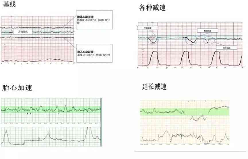 全面解读胎心监护报告：评价指标、图形分析、异常情况与应对策略