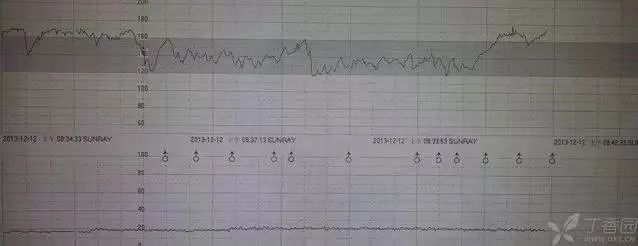 全面解读胎心监护报告：评价指标、图形分析、异常情况与应对策略