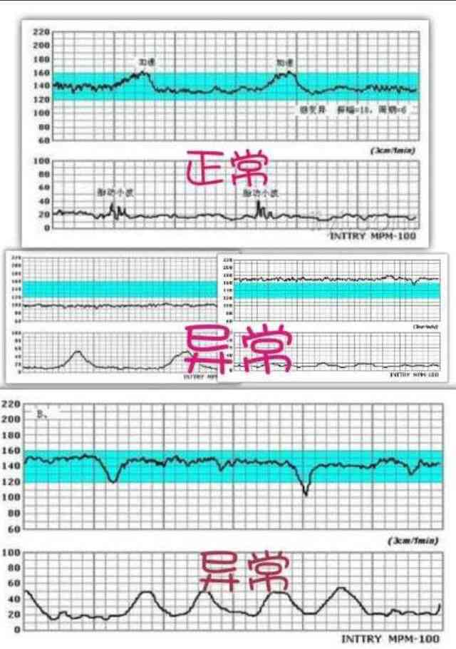 全面解读胎心监护报告：评价指标、图形分析、异常情况与应对策略