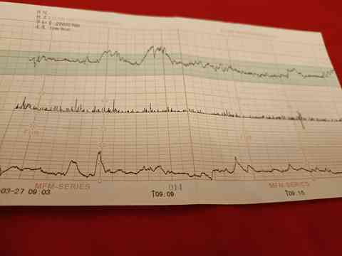 胎心监护仪ai报告是什么-胎心监护仪ai报告是什么意思啊