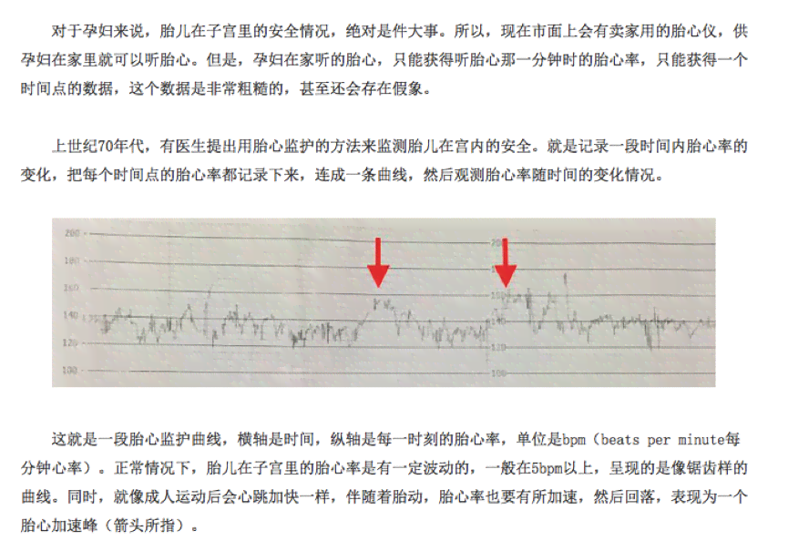 胎心监护仪ai报告是什么-胎心监护仪ai报告是什么意思啊