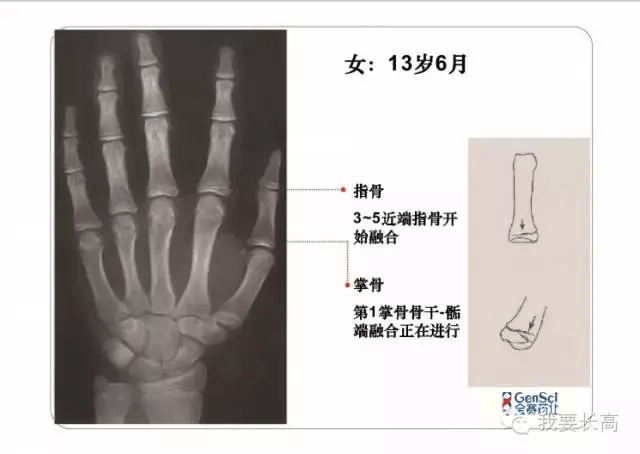 骨龄ai报告准不准-骨龄ai报告准不准确