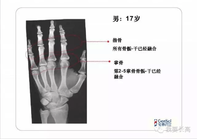 骨龄ai报告准不准-骨龄ai报告准不准确