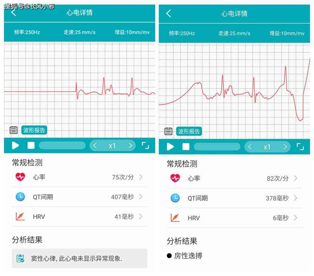 心电ai报告啥意思-心电ai报告啥意思啊